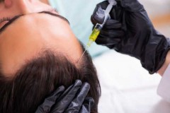 Beste haartransplantatie nederland-1